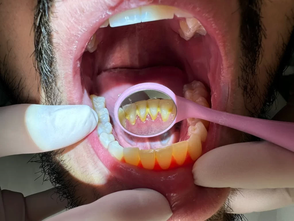 Limpieza dental profesional