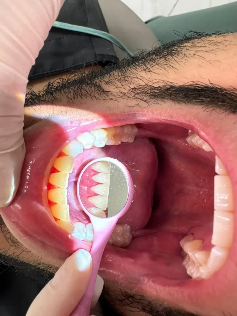 Limpieza dental profesional