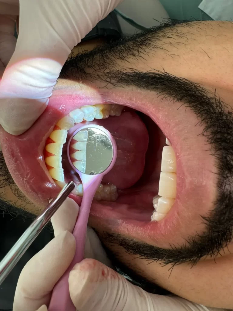 Limpieza dental profesional